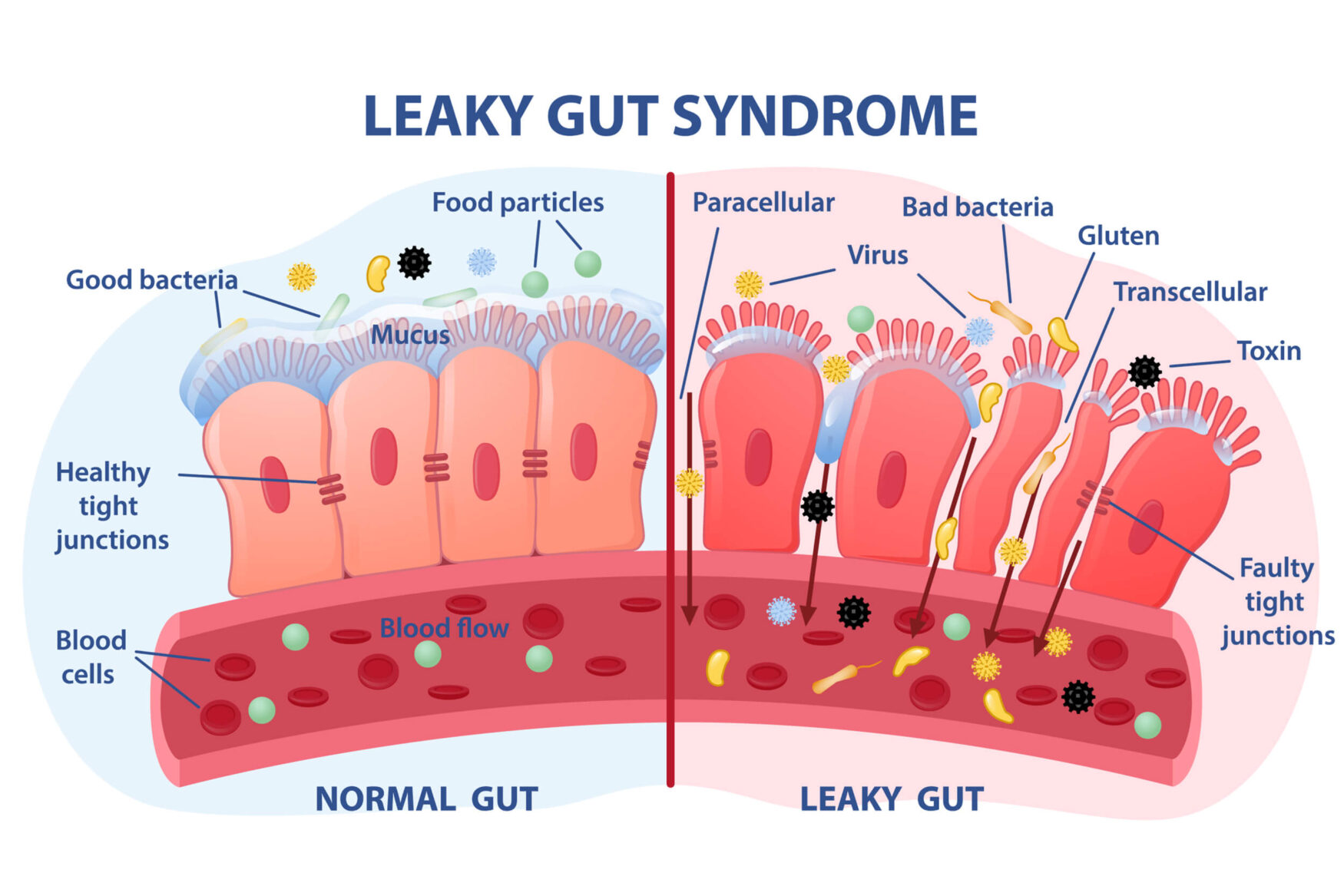 Leaky-Gut-1-2500Px